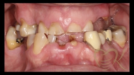 Close up of smile before overdenture