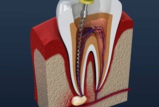 Animated tooth receiving a root canal