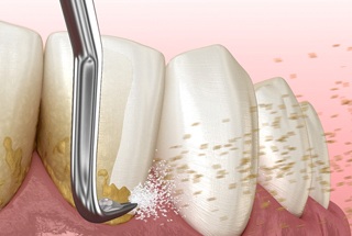 Illustration of scaling and root planing in McKinney