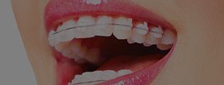 Closeup of smile with braces