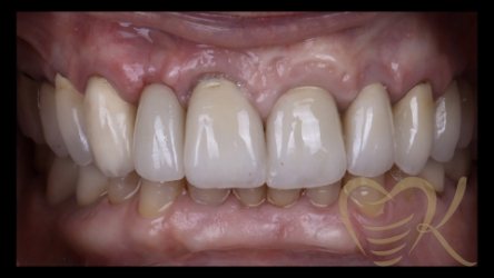 Close up of smile after getting single dental implant