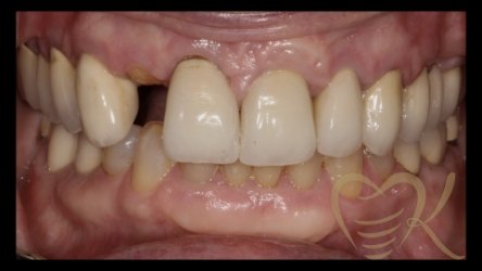 Close up of smile before single dental implant