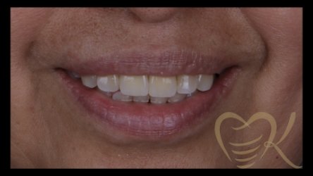 Close up of smile after getting single dental implant