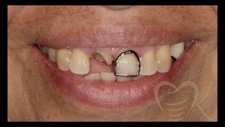 Close up of smile before single dental implant