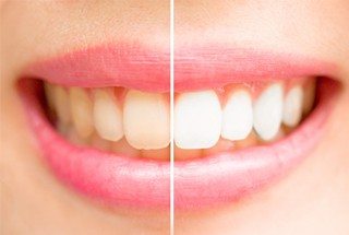 teeth whitening before after