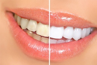 smile before and after teeth whitening