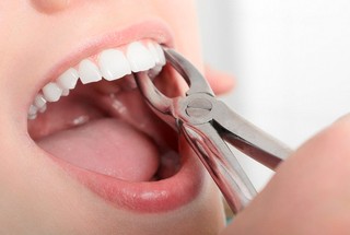 woman with mouth open for tooth extraction