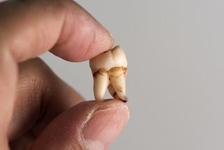 man holding tooth that has been extracted