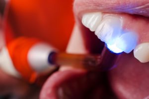 Dental bonding procedure