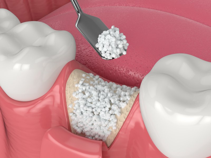 3 D diagram of a bone graft