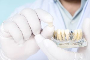 Dentist holding model dental implant with gloved hands