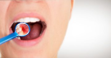 woman with gum disease brushing her teeth
