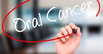 Oral cancer sign