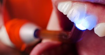 Dental bonding procedure