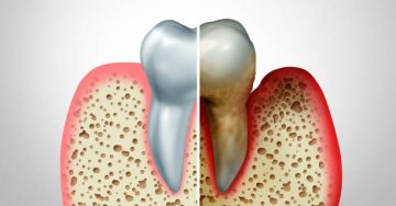 Healthy gums compared to gingivitis