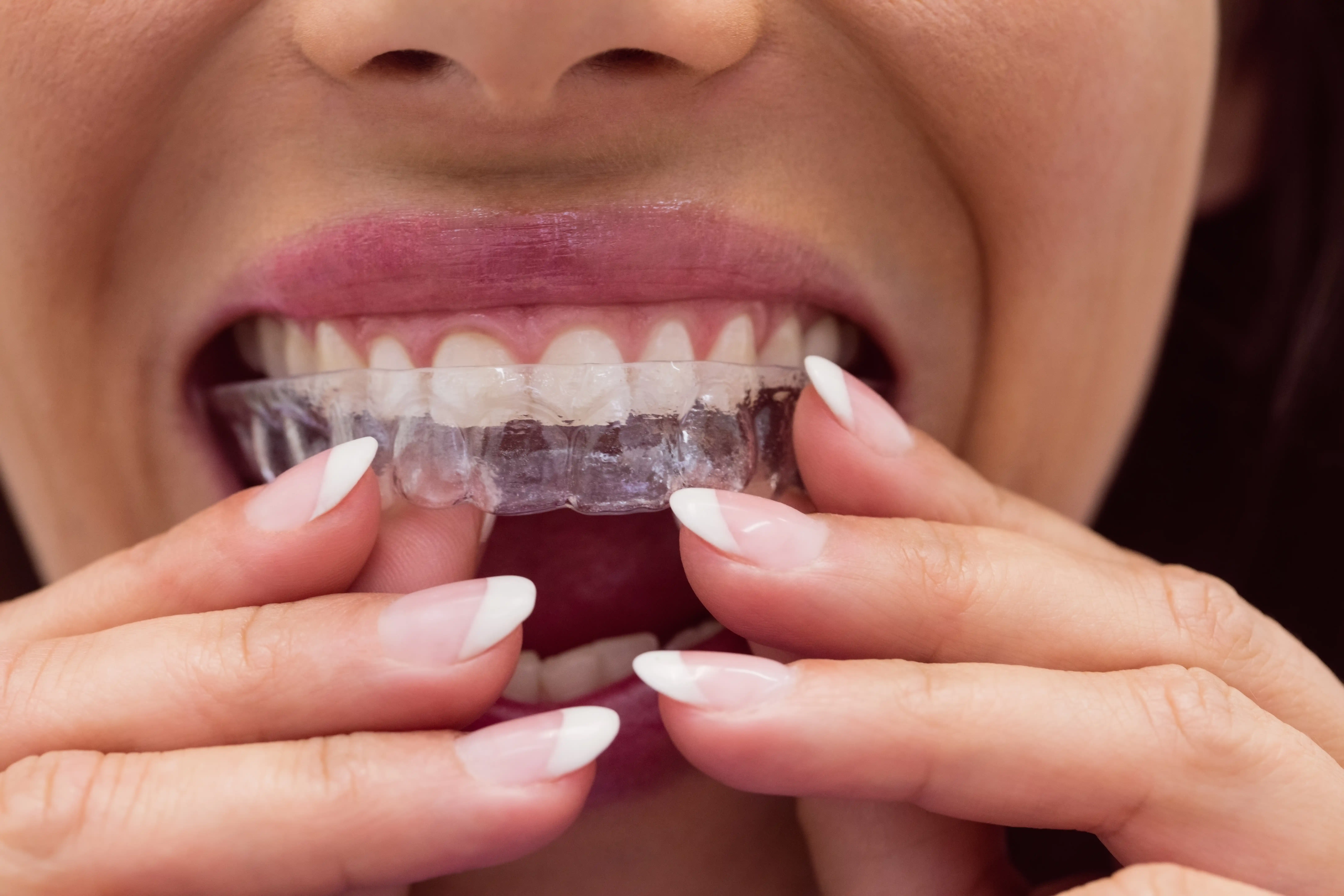 4 Reasons to Wear Your Retainer