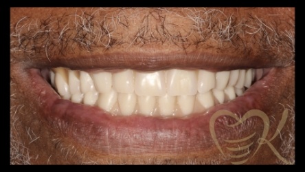 denture-1b