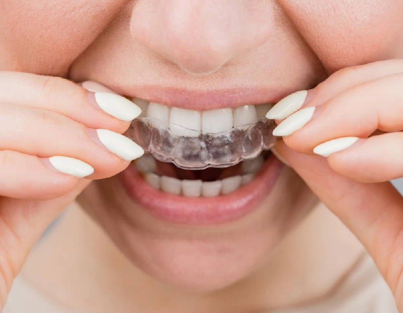 Nightguards for Bruxism