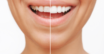 Dental veneers 1
